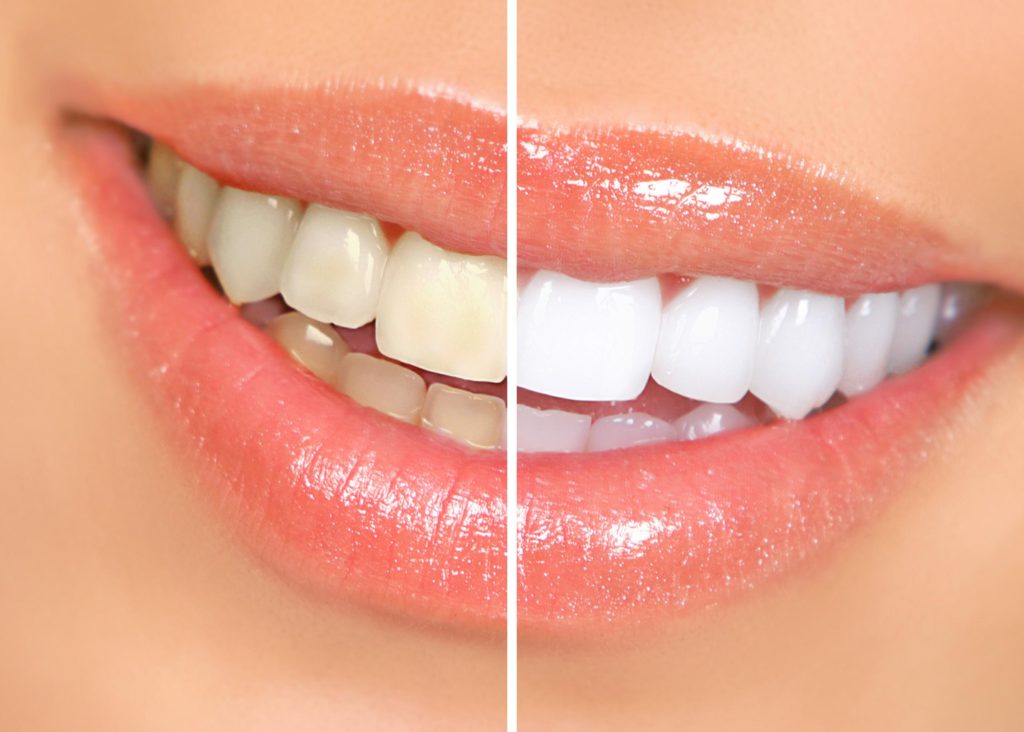 Отбеливание и виды отбеливания в стоматологии