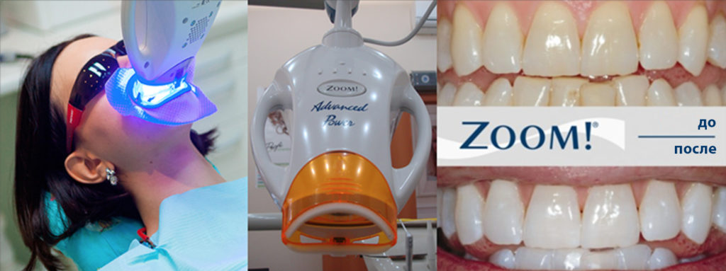Отбеливание и виды отбеливания в стоматологии