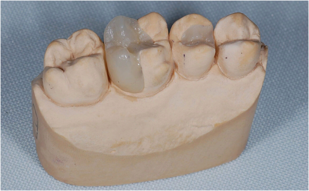 Зубные вкладки в стоматологии